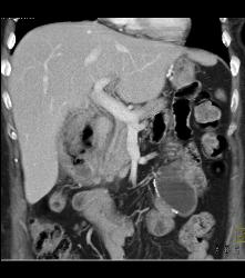 Recurrent Necrotic Tumor in Right Renal Bed - CTisus CT Scan