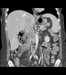 Recurrent Necrotic Tumor in Right Renal Bed - CTisus CT Scan