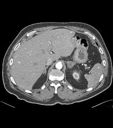 Recurrent Renal Cell Carcinoma With Liver and Splenic Metastases -isodense of Venous Phase - CTisus CT Scan