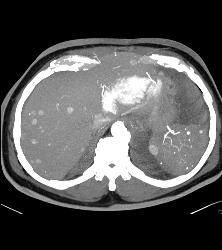 Recurrent Renal Cell Carcinoma With Liver and Splenic Metastases -isodense of Venous Phase - CTisus CT Scan