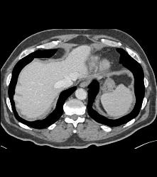 Recurrent Renal Cell Carcinoma With Liver and Splenic Metastases -isodense of Venous Phase - CTisus CT Scan