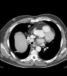 Renal Cell Carcinoma Metastatic to the Heart -right Atrium and Ventricle - CTisus CT Scan