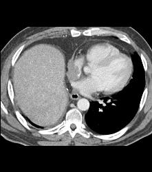 Renal Cell Carcinoma Metastatic to the Heart -right Atrium and Ventricle - CTisus CT Scan