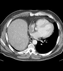 Renal Cell Carcinoma Metastatic to the Heart -right Atrium and Ventricle - CTisus CT Scan