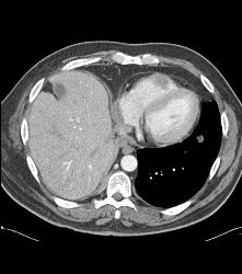 Renal Cell Carcinoma Metastatic to the Heart -right Atrium and Ventricle - CTisus CT Scan