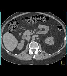 High Density Renal Cyst - CTisus CT Scan