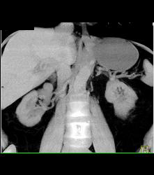 High Density Renal Cyst - CTisus CT Scan