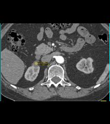 High Density Renal Cyst - CTisus CT Scan