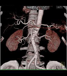 High Density Renal Cyst - CTisus CT Scan