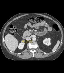 High Density Renal Cyst - CTisus CT Scan