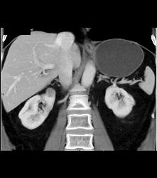 1 Cm Renal Cell Carcinoma (RCC) - CTisus CT Scan