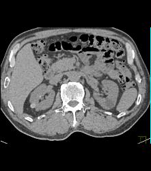 High Density Renal Cyst - CTisus CT Scan