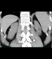 High Density Renal Cyst - CTisus CT Scan