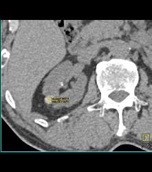 High Density Renal Cyst - CTisus CT Scan