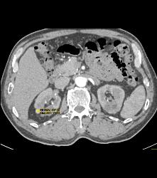 High Density Renal Cyst - CTisus CT Scan