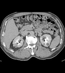 High Density Renal Cyst - CTisus CT Scan