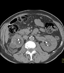 Normal Appearance S/p Radiofrequency Ablation (RFA) - CTisus CT Scan