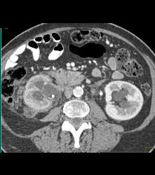 Normal Appearance S/p Radiofrequency Ablation (RFA) - CTisus CT Scan