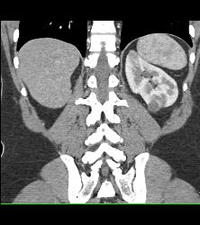 2 Cm Renal Cell Carcinoma - CTisus CT Scan