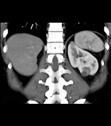 2 Cm Renal Cell Carcinoma - CTisus CT Scan