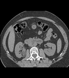 3 Cm Angiomyolipoma (AML) - CTisus CT Scan