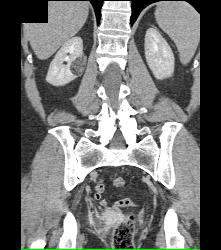 3 Cm Angiomyolipoma (AML) - CTisus CT Scan