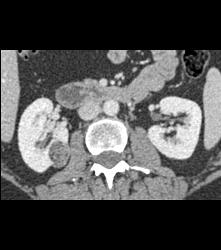 3 Cm Angiomyolipoma (AML) - CTisus CT Scan