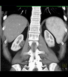 3 Cm Angiomyolipoma (AML) - CTisus CT Scan