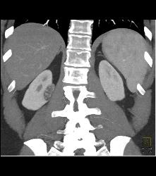 3 Cm Angiomyolipoma (AML) - CTisus CT Scan