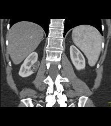 3 Cm Angiomyolipoma (AML) - CTisus CT Scan