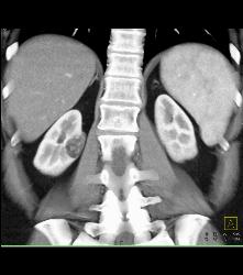 3 Cm Angiomyolipoma (AML) - CTisus CT Scan