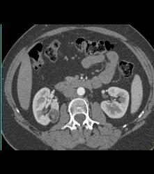 3 Cm Angiomyolipoma (AML) - CTisus CT Scan