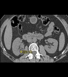 3 Cm Angiomyolipoma (AML) - CTisus CT Scan