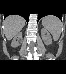 3 Cm Angiomyolipoma (AML) - CTisus CT Scan