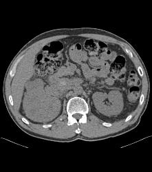 Renal Cell Carcinoma Invades the Renal Vein and IVC - See Full Sequence - CTisus CT Scan