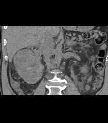 Renal Cell Carcinoma Invades the Renal Vein and IVC - See Full Sequence - CTisus CT Scan