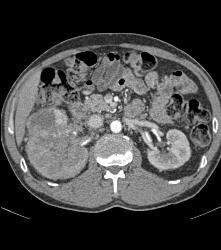 Renal Cell Carcinoma Invades the Renal Vein and IVC - See Full Sequence - CTisus CT Scan