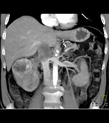 Renal Cell Carcinoma Invades the Renal Vein and IVC - See Full Sequence - CTisus CT Scan