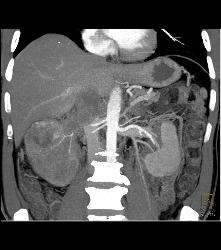 Renal Cell Carcinoma Invades the Renal Vein and IVC - See Full Sequence - CTisus CT Scan