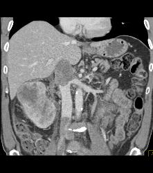 Renal Cell Carcinoma Invades the Renal Vein and IVC - See Full Sequence - CTisus CT Scan