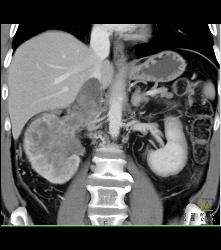 Renal Cell Carcinoma Invades the Renal Vein and IVC - See Full Sequence - CTisus CT Scan