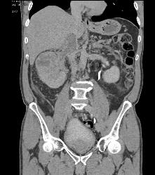 Renal Cell Carcinoma Invades the Renal Vein and IVC - See Full Sequence - CTisus CT Scan