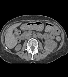 Left Perirenal Bleed S/p Bx - CTisus CT Scan