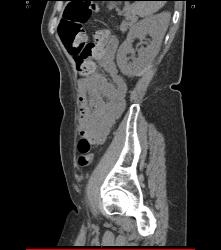 Left Perirenal Bleed S/p Bx - CTisus CT Scan