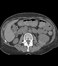 Left Perirenal Bleed S/p Bx - CTisus CT Scan