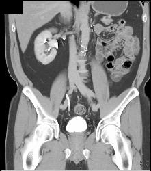 Recurrent Tumor in Left Renal Bed - CTisus CT Scan