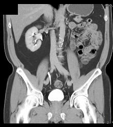 Recurrent Tumor in Left Renal Bed - CTisus CT Scan