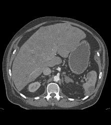 Metastatic Melanoma With Liver, Spleen, Left Perirenal and Paracardiac Nodes - CTisus CT Scan