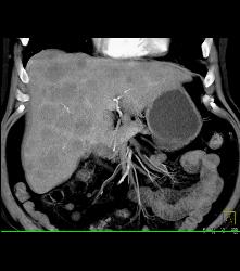 Metastatic Melanoma With Liver, Spleen, Left Perirenal and Paracardiac Nodes - CTisus CT Scan