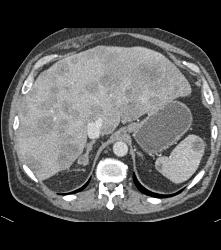 Metastatic Melanoma With Liver, Spleen, Left Perirenal and Paracardiac Nodes - CTisus CT Scan